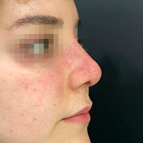 Rinoplastía &lt;h6&gt;(cirugía de nariz)&lt;/h6&gt;