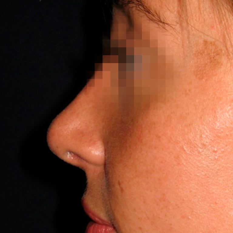 Rinoplastía &lt;h6&gt;(cirugía de nariz)&lt;/h6&gt;