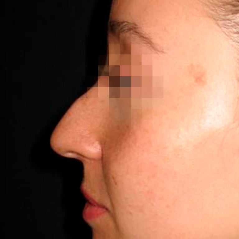 Rinoplastía &lt;h6&gt;(cirugía de nariz)&lt;/h6&gt;