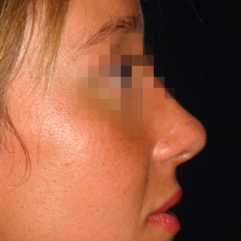 Rinoplastía &lt;h6&gt;(cirugía de nariz)&lt;/h6&gt;