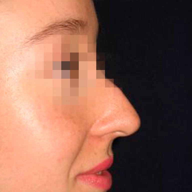 Rinoplastía &lt;h6&gt;(cirugía de nariz)&lt;/h6&gt;