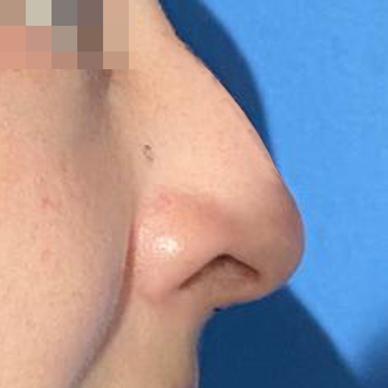 Rinoplastía &lt;h6&gt;(cirugía de nariz)&lt;/h6&gt;