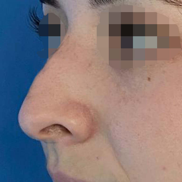 Rinoplastía &lt;h6&gt;(cirugía de nariz)&lt;/h6&gt;