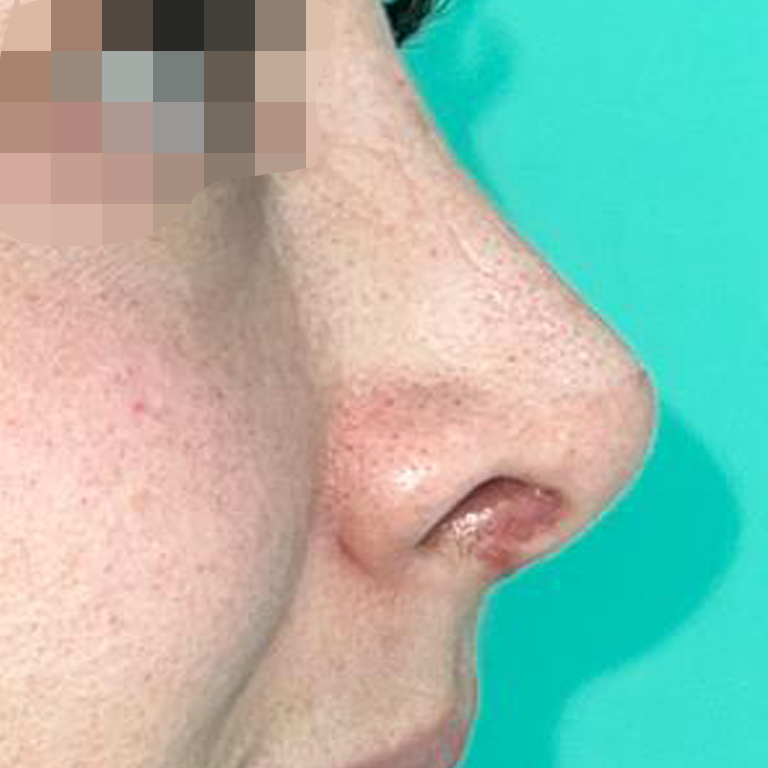 Rinoplastía &lt;h6&gt;(cirugía de nariz)&lt;/h6&gt;