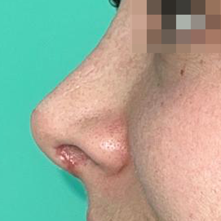 Rinoplastía &lt;h6&gt;(cirugía de nariz)&lt;/h6&gt;