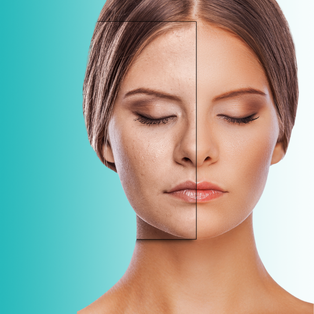 Fotorejuvenecimiento Facial