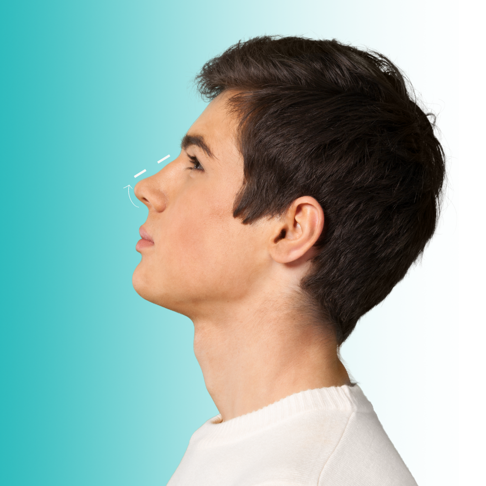 Rinoplastía