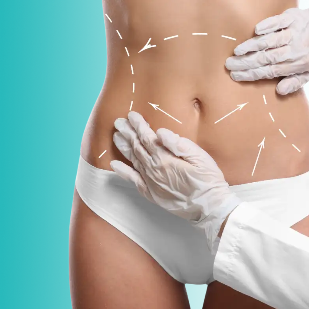 Cirugía abdominoplastía