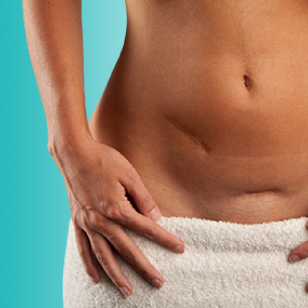 Cicatrices inestéticas, hipertróficas y queloides