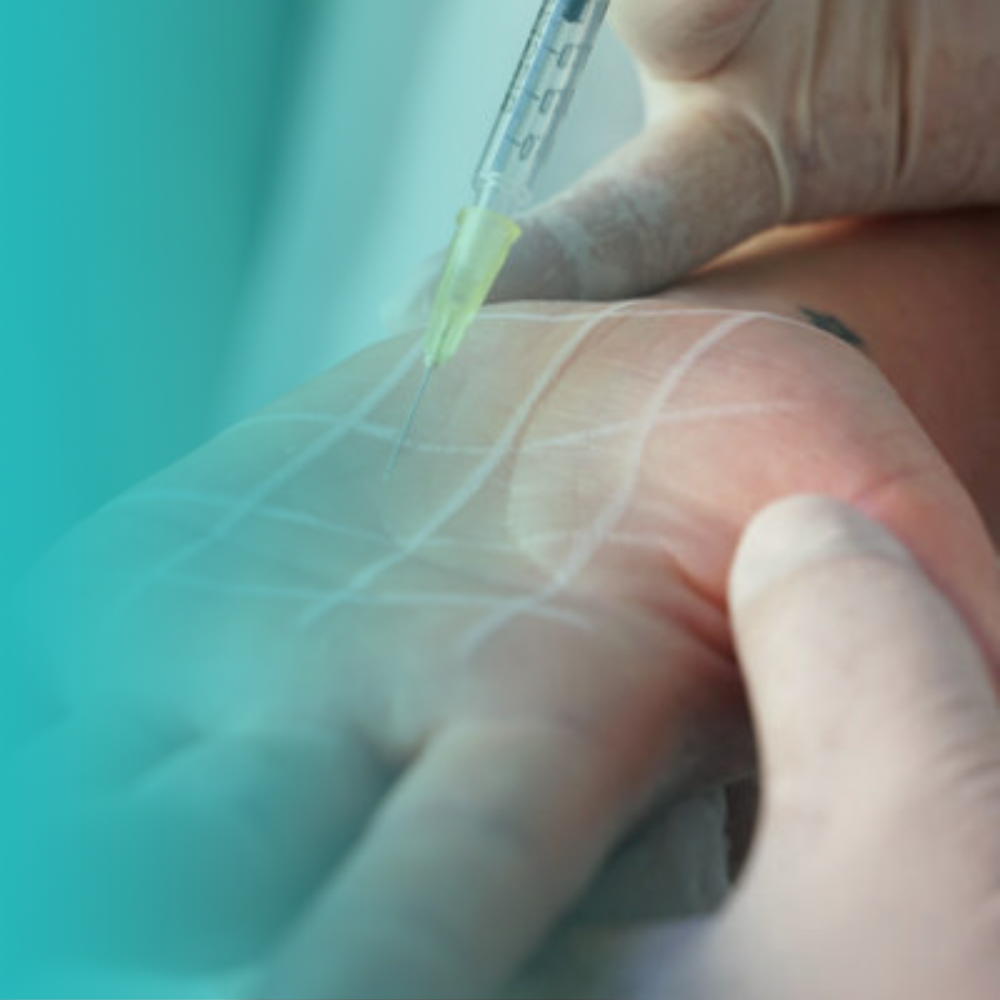 Hiperhidrosis Palmar y Plantar