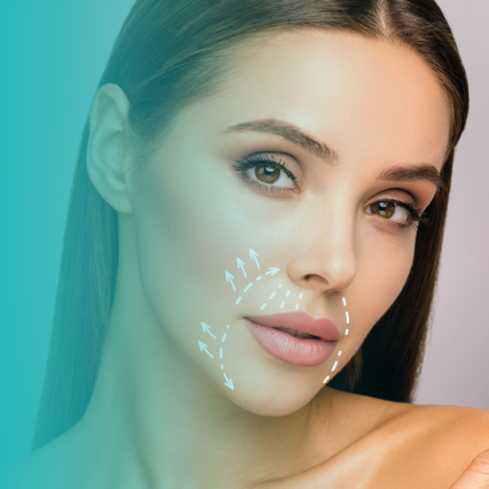 Relleno de Surco Nasogeniano